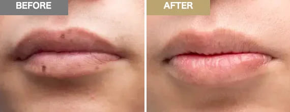 ゴリラクリニックで唇のほくろを除去したビフォーアフター画像（症例写真）